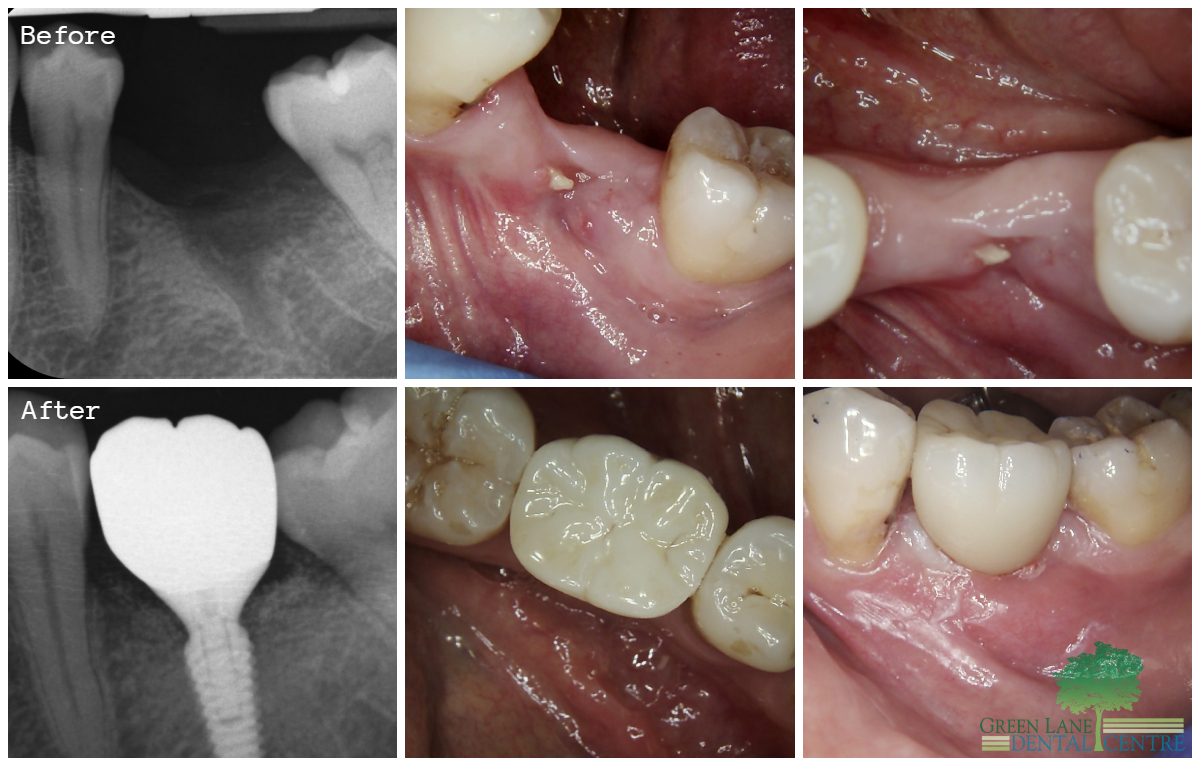 Hard and Soft Tissue Graft Before and After