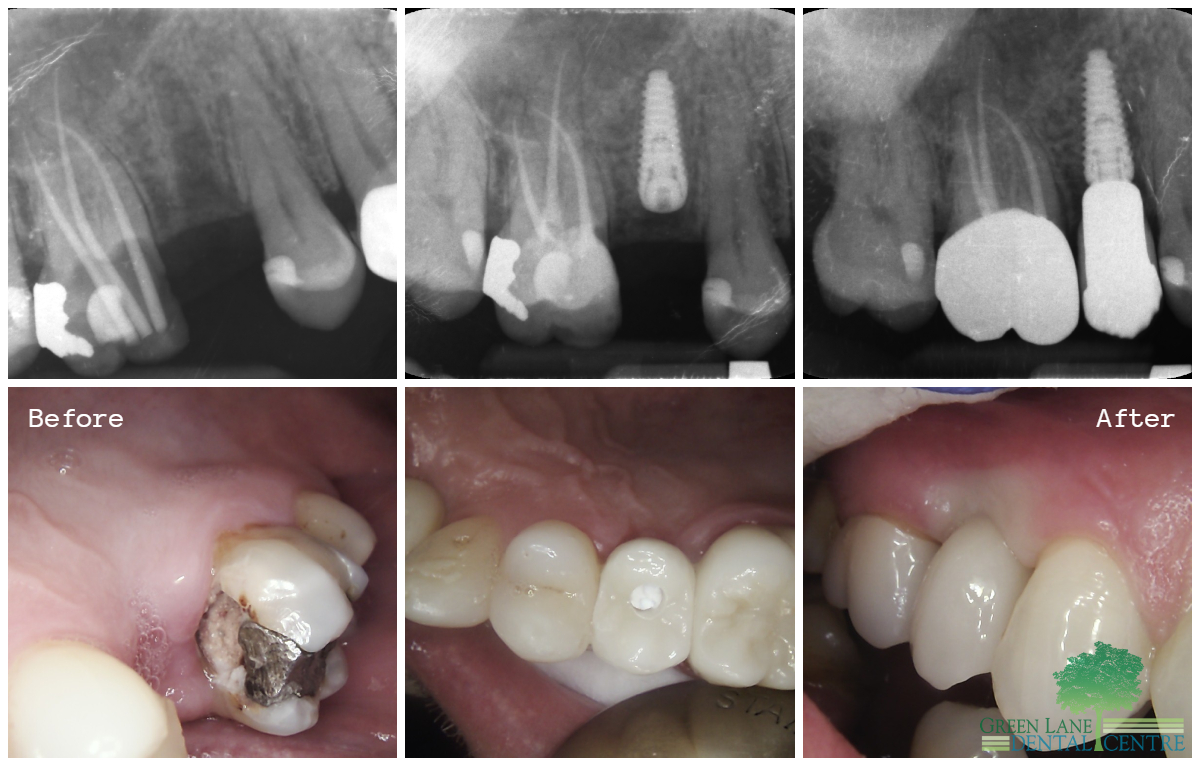 Implant placement Before and After