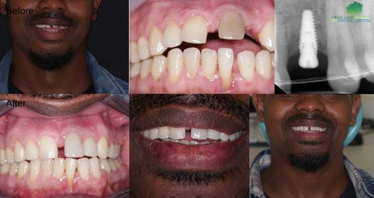 Combination Of Implants Before and After