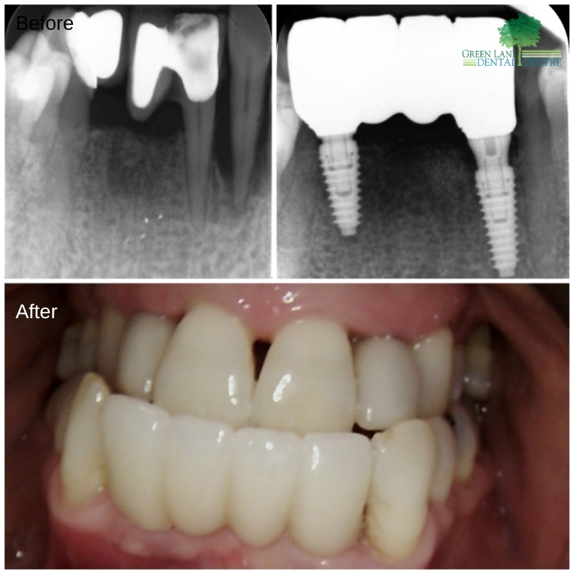 Bridge on Implants Before and After