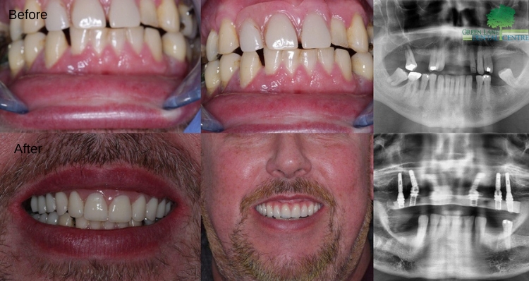 All on 6 / Full Upper Bridge Before and After