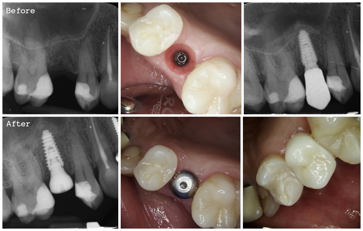 Sinus Lift and Immediate Implant Placement Before and After