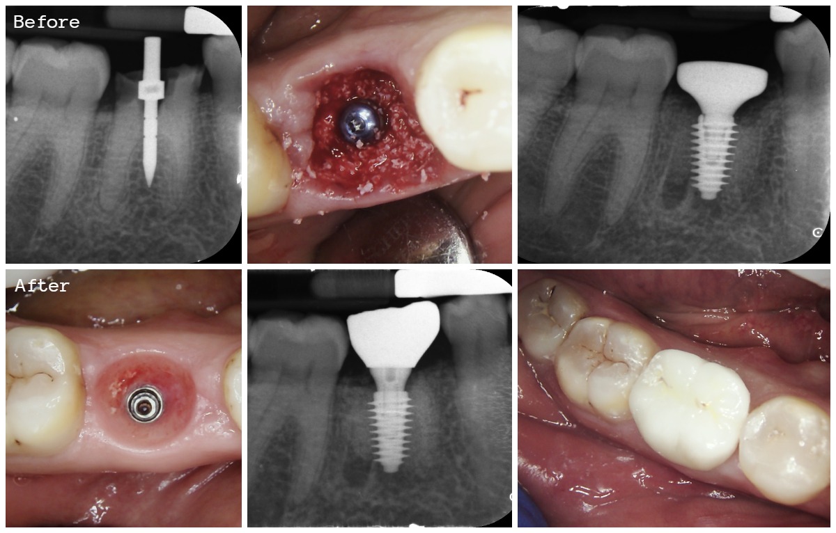 Immediate Implant Placement Before and After