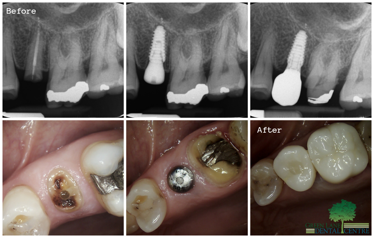 Immediate Implant Before and After
