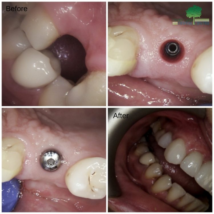 Single Implant Placement Before and After