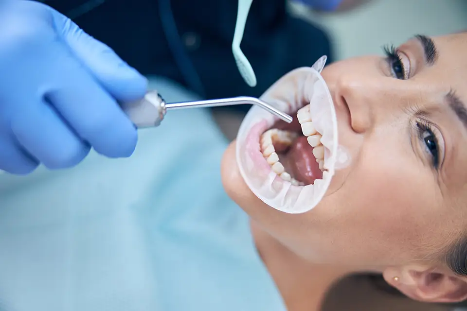 What Are Tooth Coloured Fillings? A Complete Guide for Patients