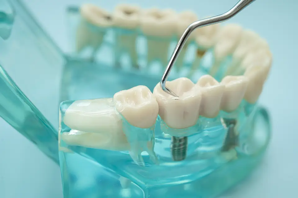Types of Dental Implants: A Complete Guide