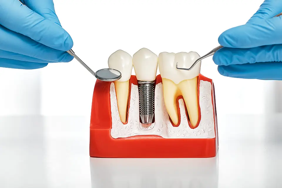 Subperiosteal Implants: A Complete Guide for Patients with Severe Bone Loss