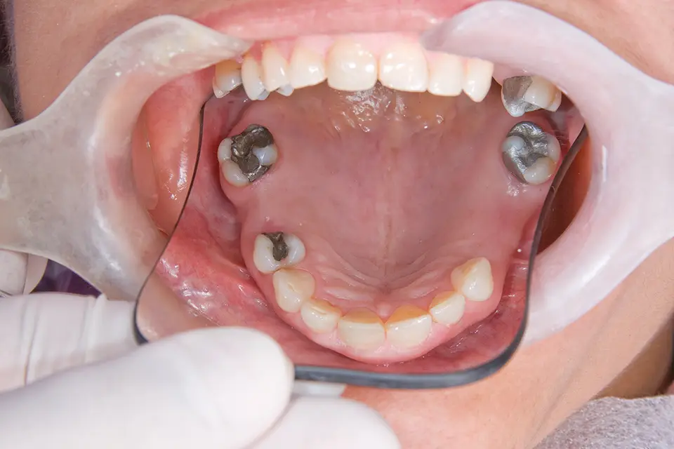 Endosteal Implants: A Patient's Guide to a Permanent Tooth Replacement Solution