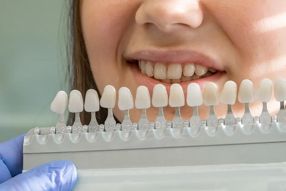 Porcelain Veneers: A Clear, Practical Guide to a Natural-Looking Smile