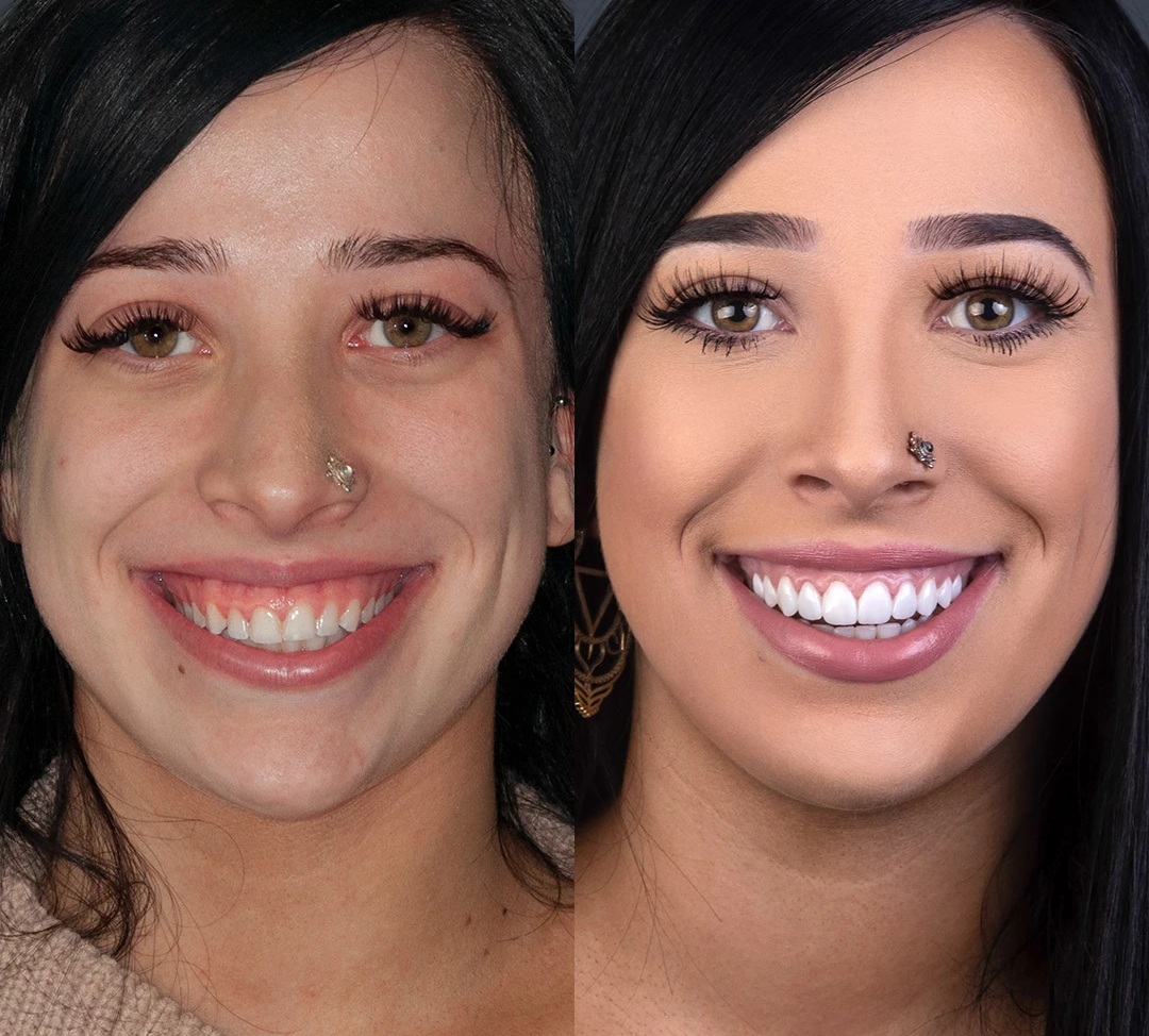 Laser Gum Contouring Before and After 2