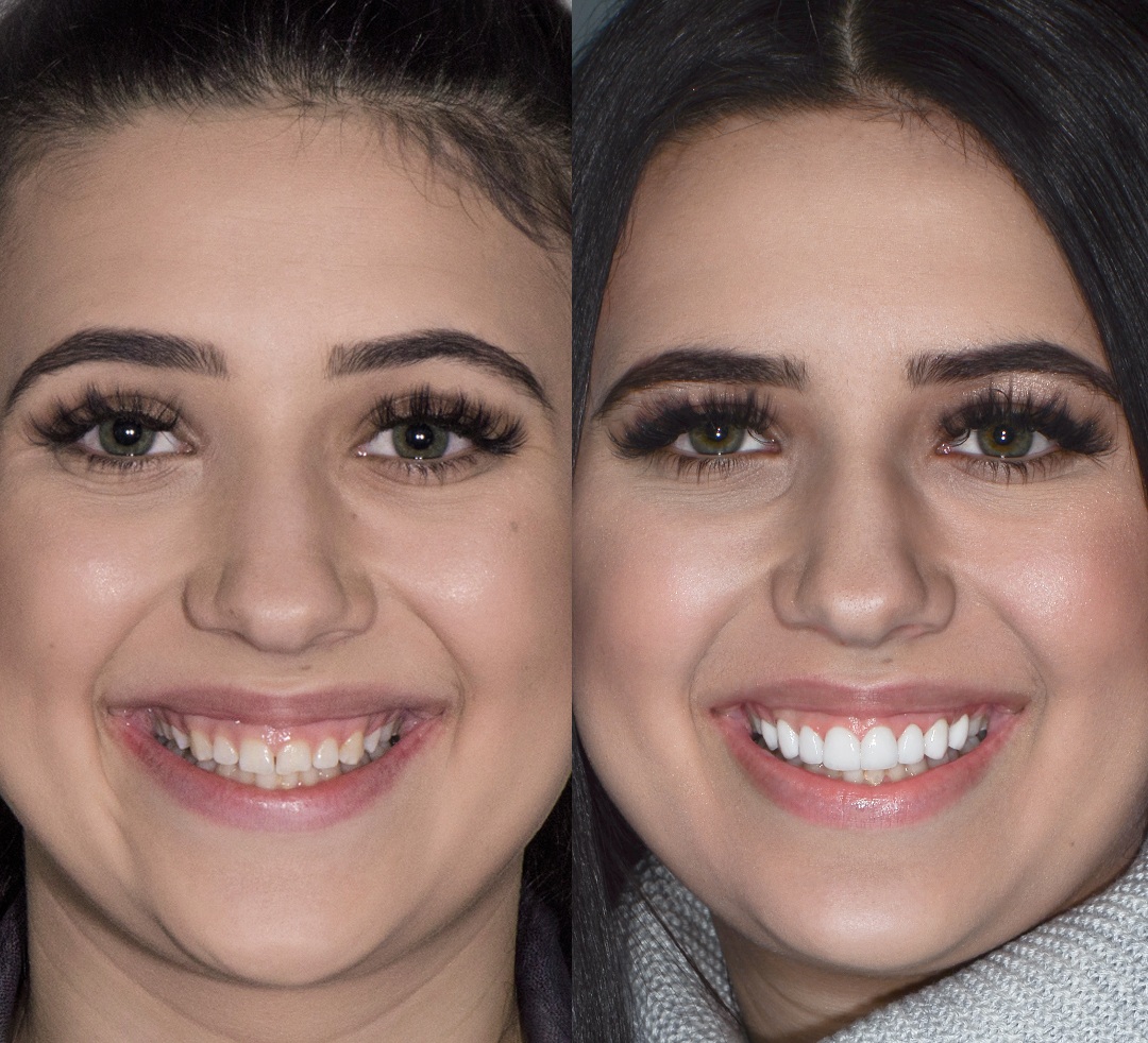 laser-gum-contouring-b&f4