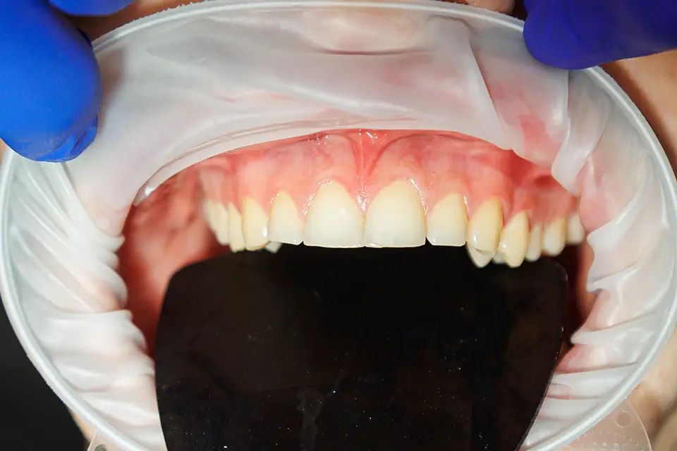Ridge Augmentation Before Dental Implants: What to Expect in Sidcup