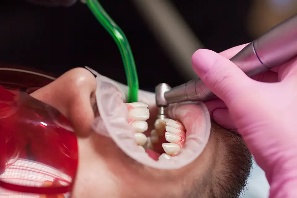 What Is Ridge Augmentation?