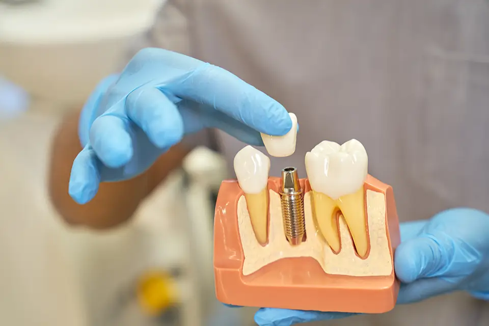 Mini Dental Implants in Sidcup: Cost, Procedure & Suitability