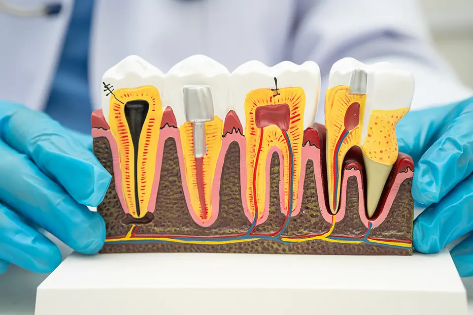 What Is Guided Tissue Regeneration (GTR)?