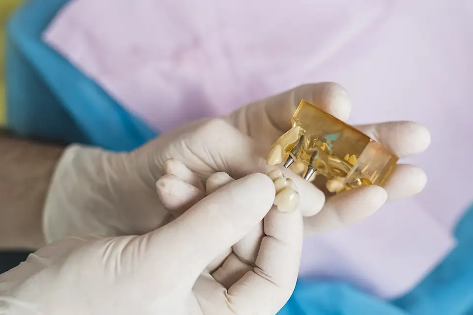 Why Guided Bone Regeneration Is Recommended Before Dental Implants