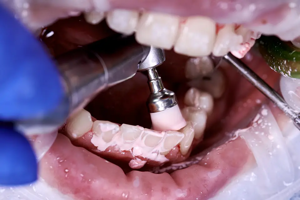 When Dentists Recommend GTR vs GBR (Common Clinical Scenarios)
