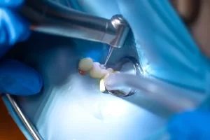 Guided Bone Regeneration (GBR) for Dental Implants: Cost, Healing Time, and Who Needs It