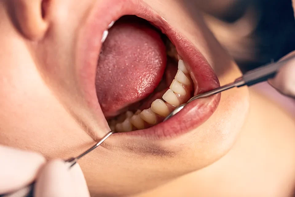 Dental Bridges-04