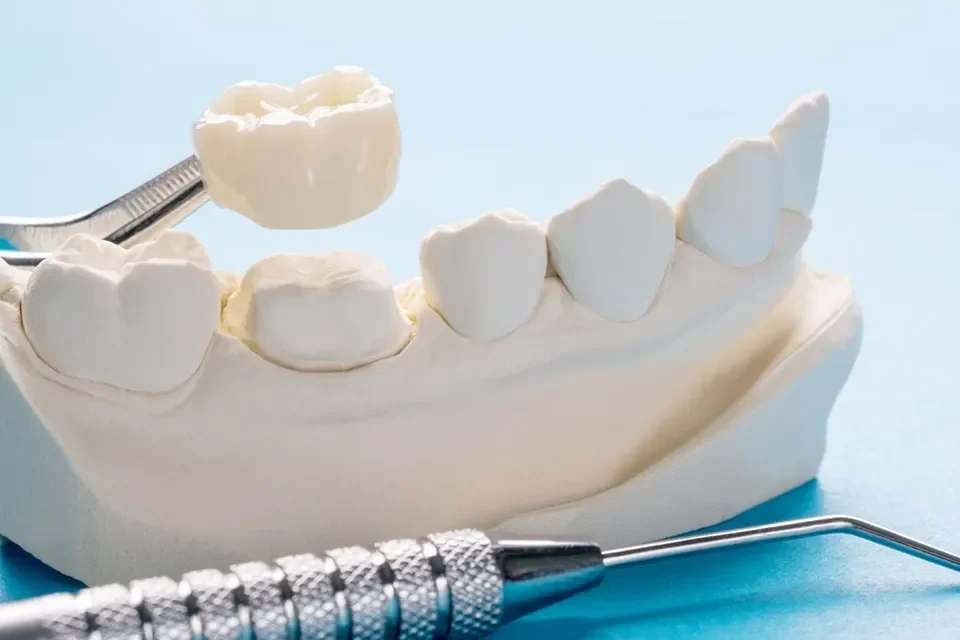 Dental Crowns 1