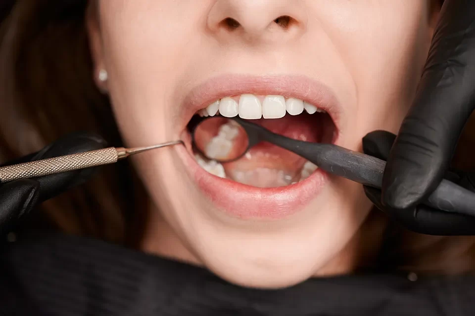 Dental Fillings-04