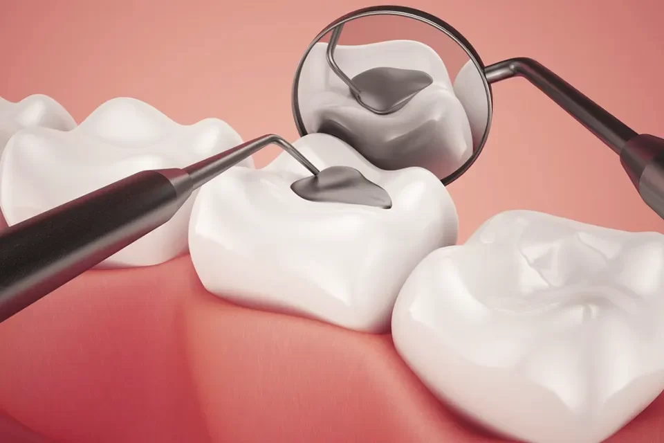Dental Fillings 1
