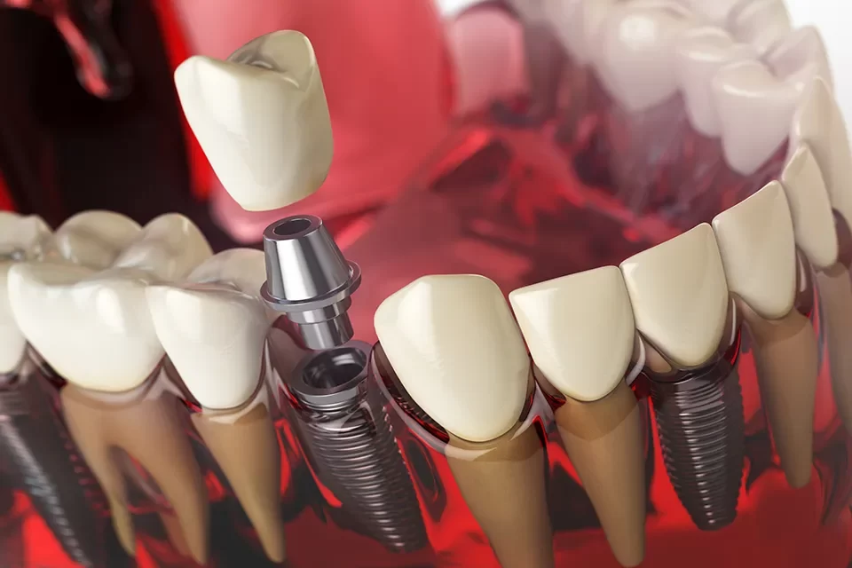 What are Dental Implants ?