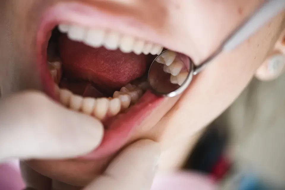 Dental Fillings
