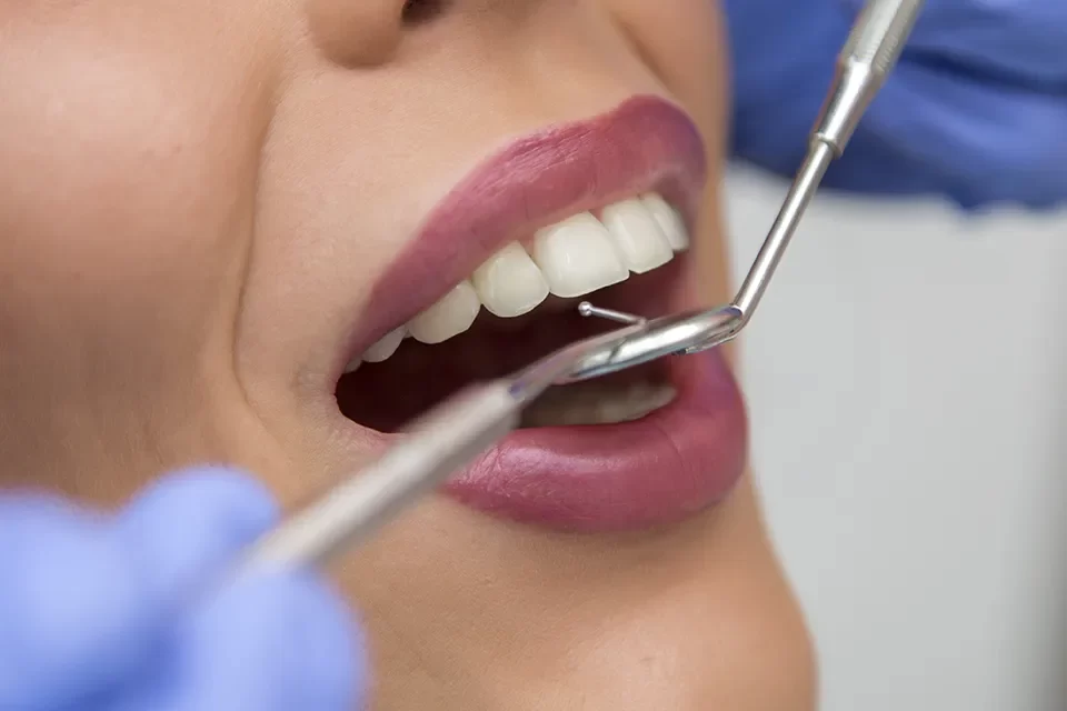 The Dental Veneers Procedure