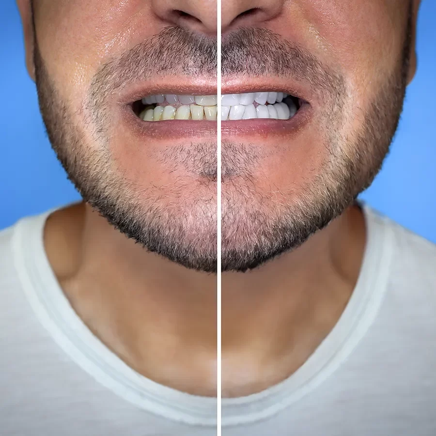 Benefits of Dental Whitening Treatment