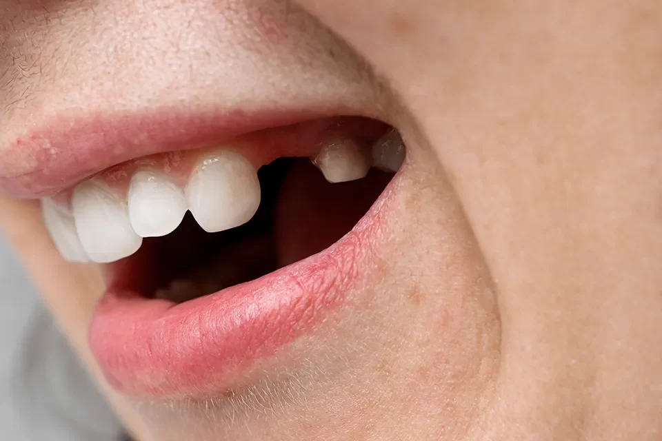 Tooth Extractions-04