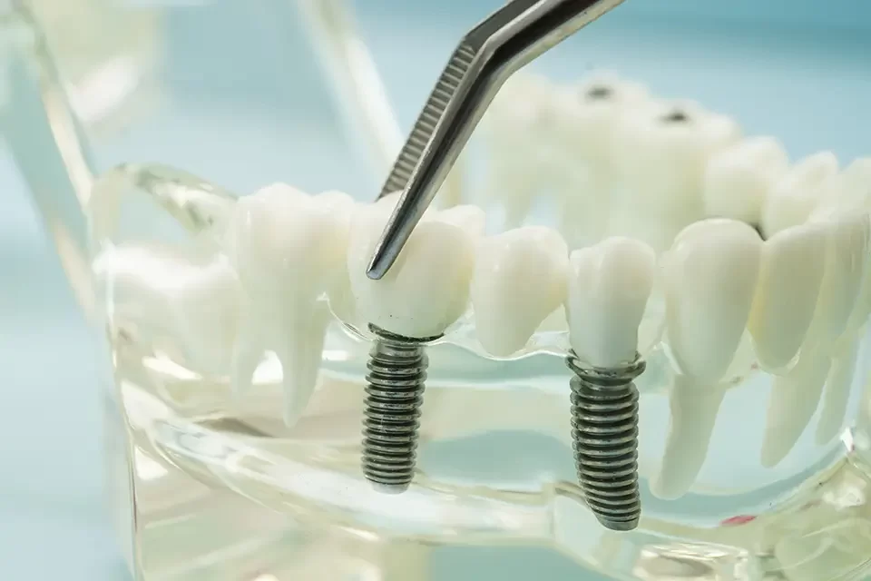Mini Dental Implants: Pros And Cons