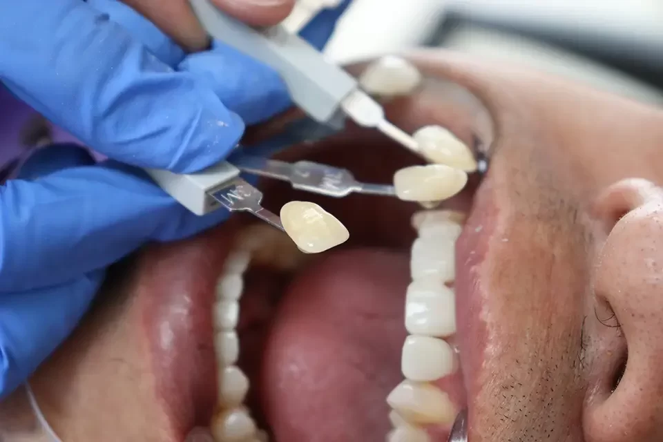 Tooth Coloured Fillings Pros and Cons