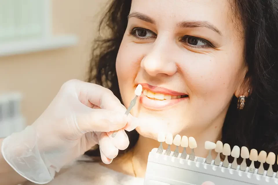 Acrylic Veneers Cost in the UK and Sidcup