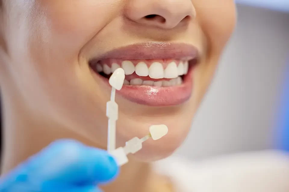 What are Same-Day Veneers?