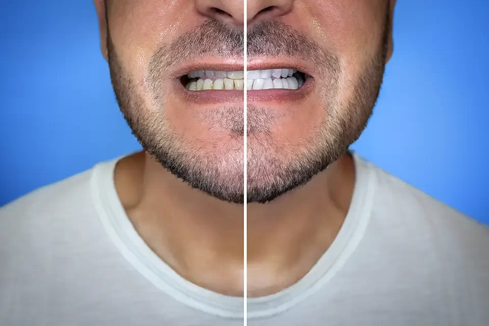 Laser Teeth Whitening Before/ After