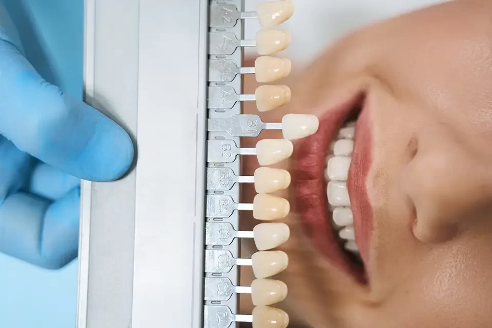 What Are Acrylic Veneers and How Do They Work?